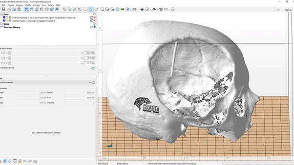 Mô hình 3D của hộp sọ Adriana, được tạo từ dữ liệu chụp CT, cho thấy lượng xương đáng kể bị mất do biến chứng của chứng phình động mạch não.