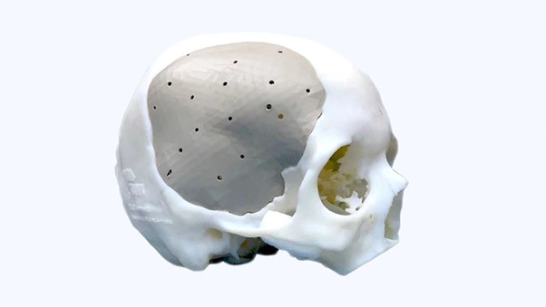 Render hộp sọ của Adriana với thiết kế Implant